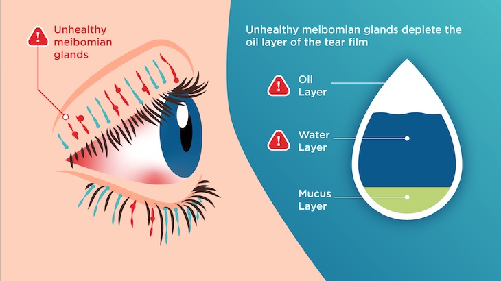Digram of how tear care helps control MGD symptoms